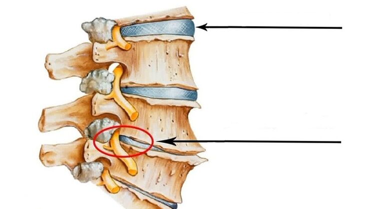увреждане на гръбначния стълб при цервикална остеохондроза