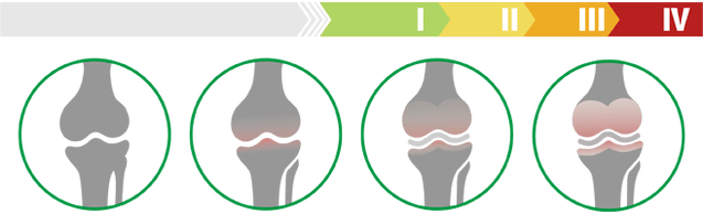 Клинични стадии на артроза на колянната става (степен на артроза на колянната става)