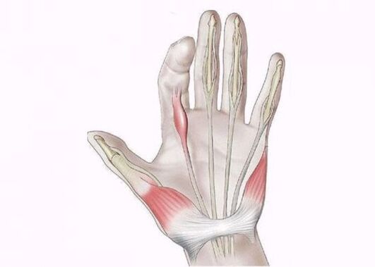 възпаление на сухожилията като причина за болка в ставите на пръстите