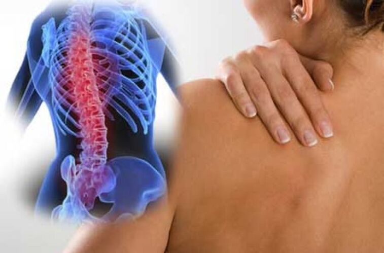 По време на обостряне на остеохондрозата на гръдния кош се появява болка в гърба. 