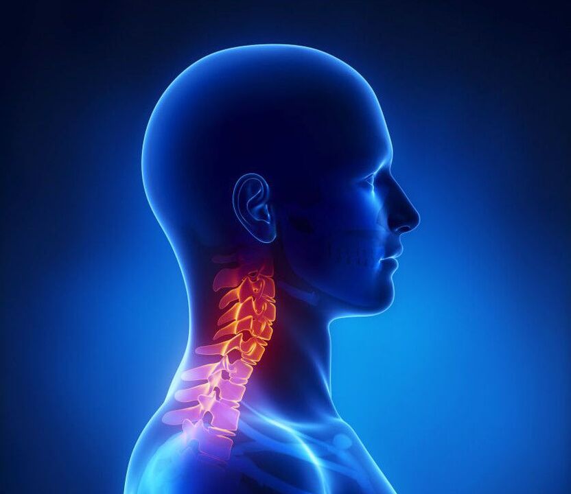 Цервикалната остеохондроза е патология на гръбначния стълб, от която можете да се отървете у дома