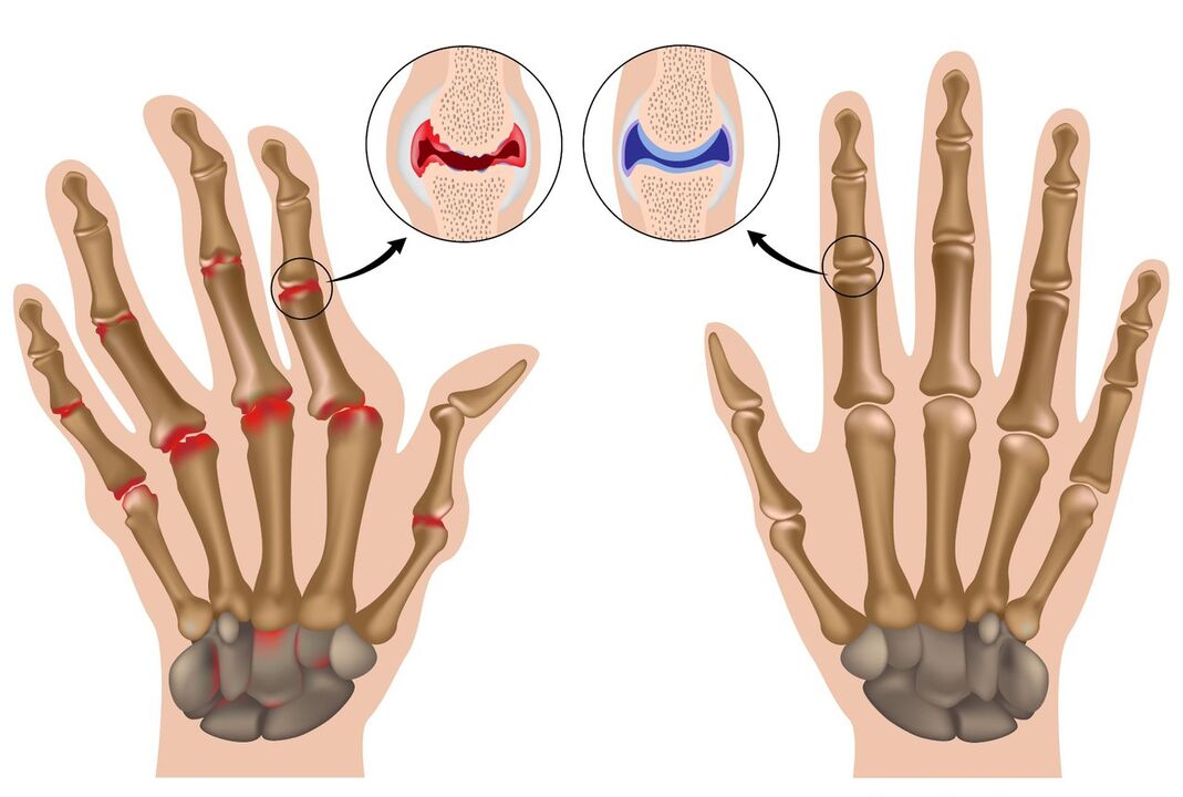 Здрави и засегнати от полиартрит стави на ръцете