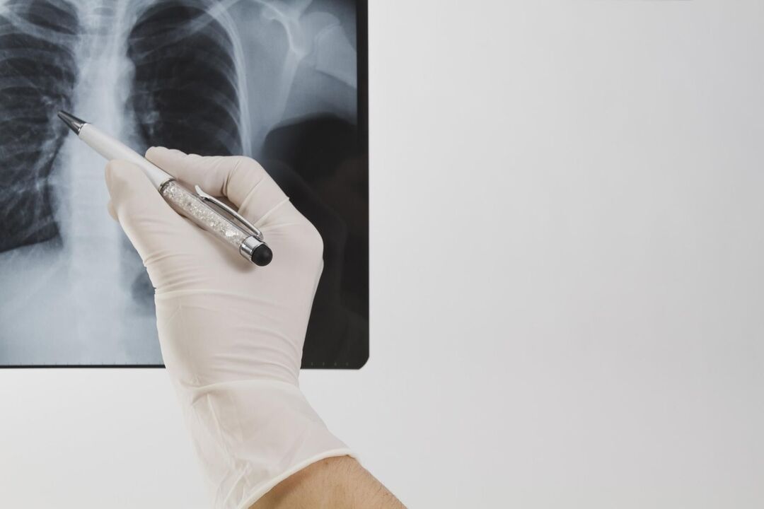 Рентгенова снимка за диагностициране на остеохондроза