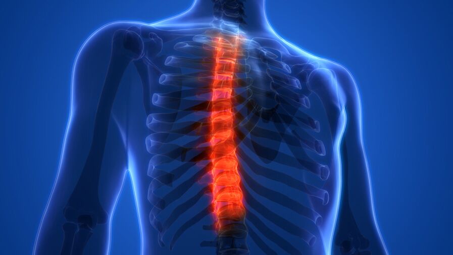 Остеохондроза на гръдния кош, характеризираща се с разрушаване на междупрешленните дискове. 